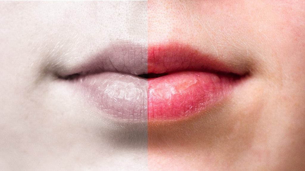 Home remedies to treat dark lips